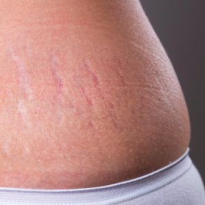 Stretch Marks Removal in Gurgaon