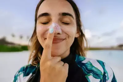 Melasma
