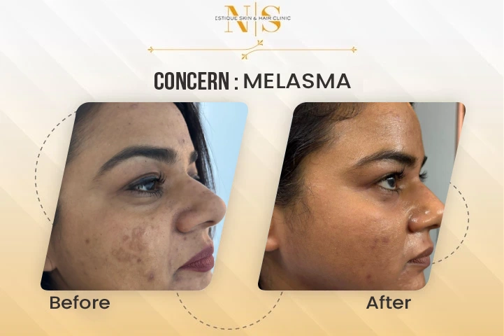melasma