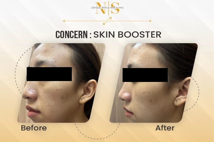 skin-booster