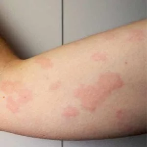 Urticaria Treatment in Gurgaon