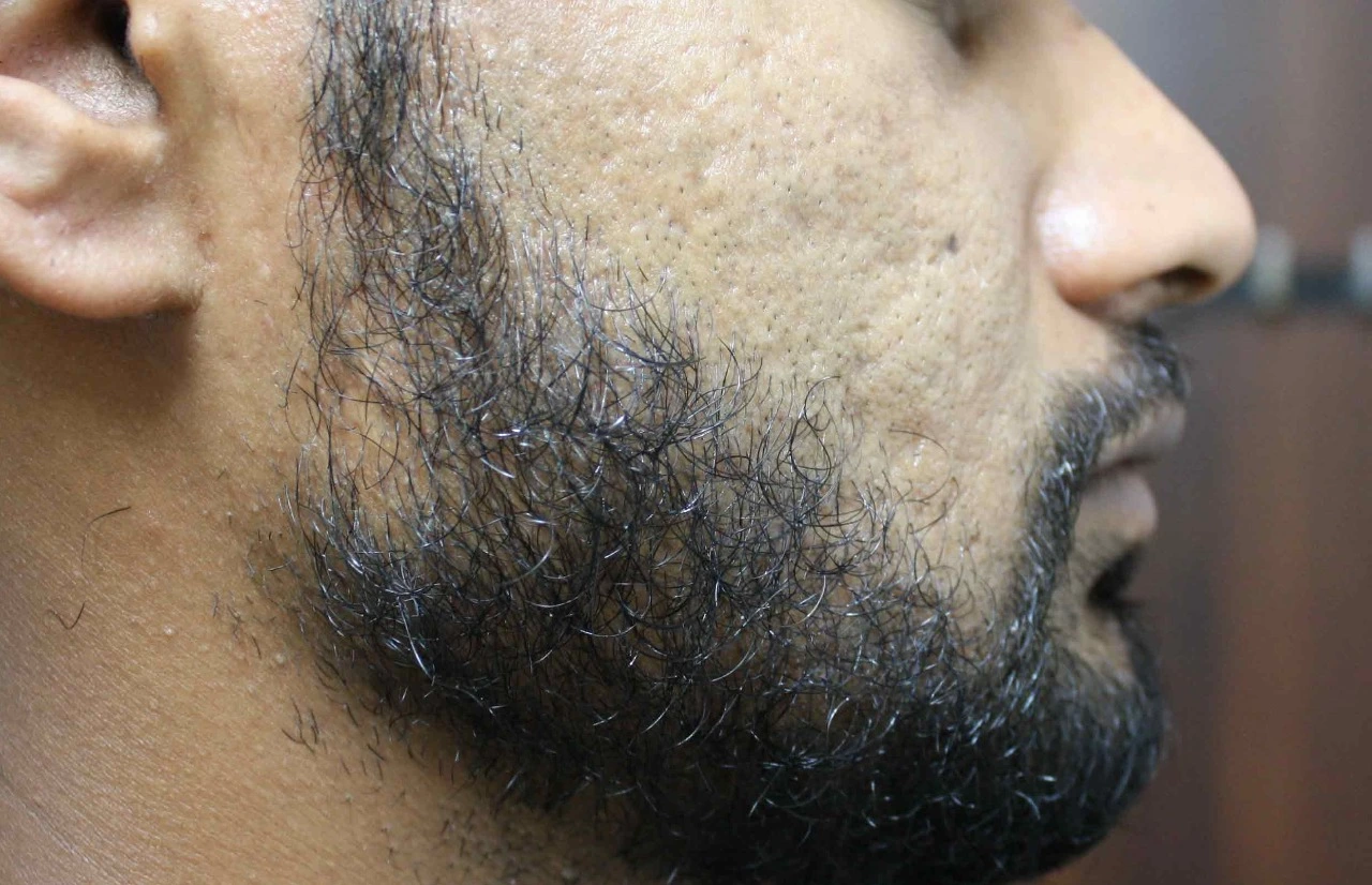 acne Treatment Cost in Gurgaon