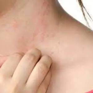 Eczema Treatment in Gurgaon