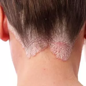 Best Psoriasis Treatment in Gurgaon