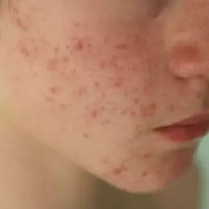 Best Rosacea Treatment in Gurgaon
