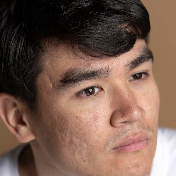 Facial Dermal Fillers Treatment in Gurgaon