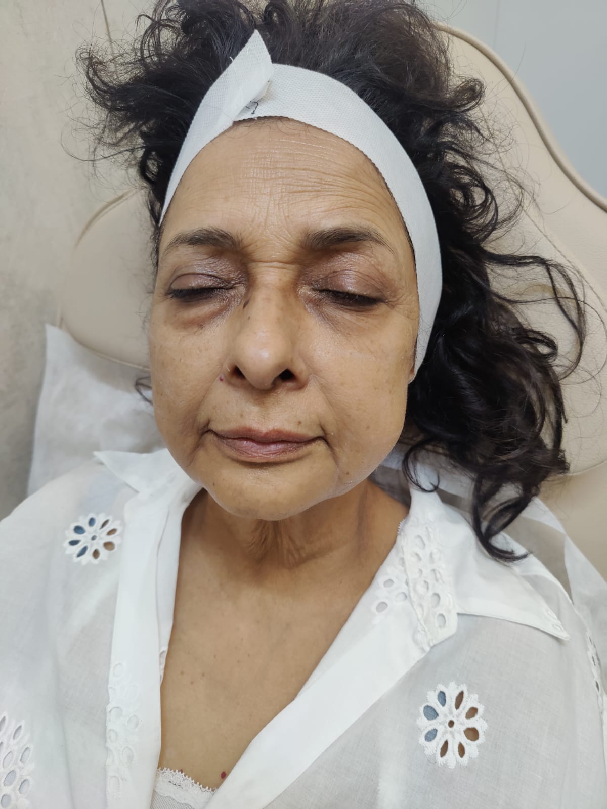 Skin Boosters Treatmentin Gurgaon