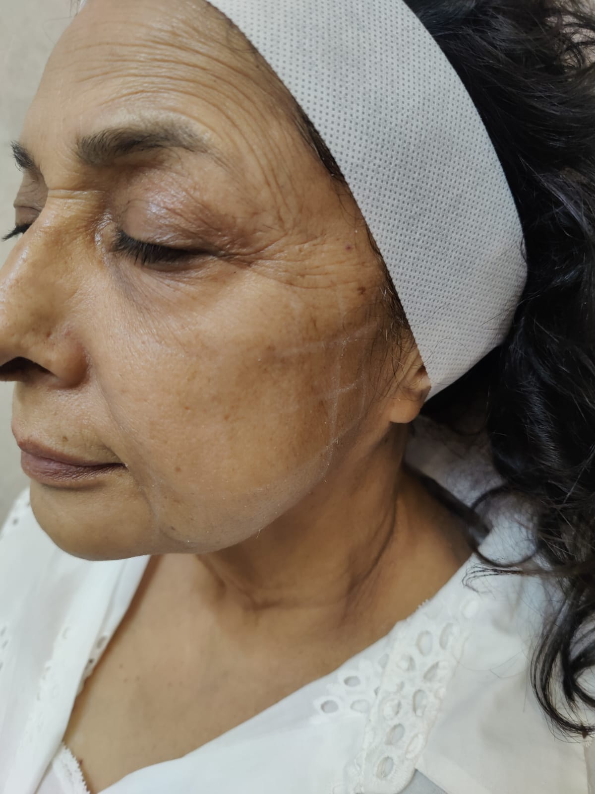 Skin Boosters Treatmentin Gurgaon