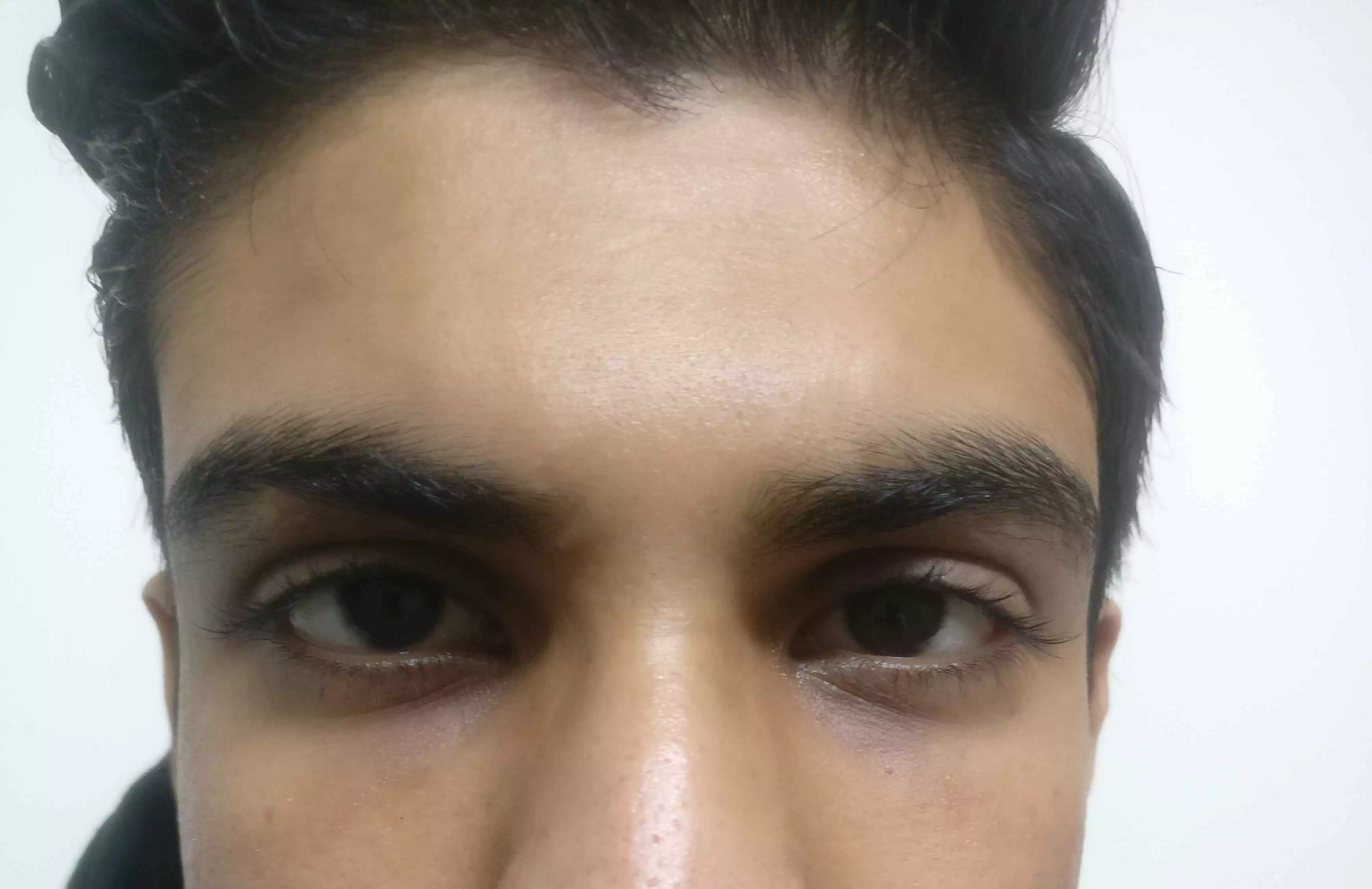 Dark Circles Treatment in Gurgaon