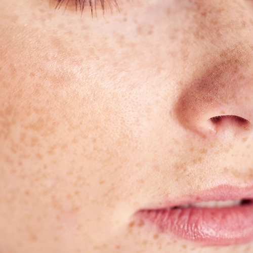Freckles Treatment in Gurgaon