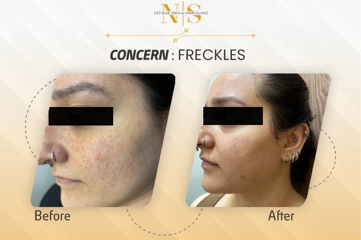 Before and After Result 3