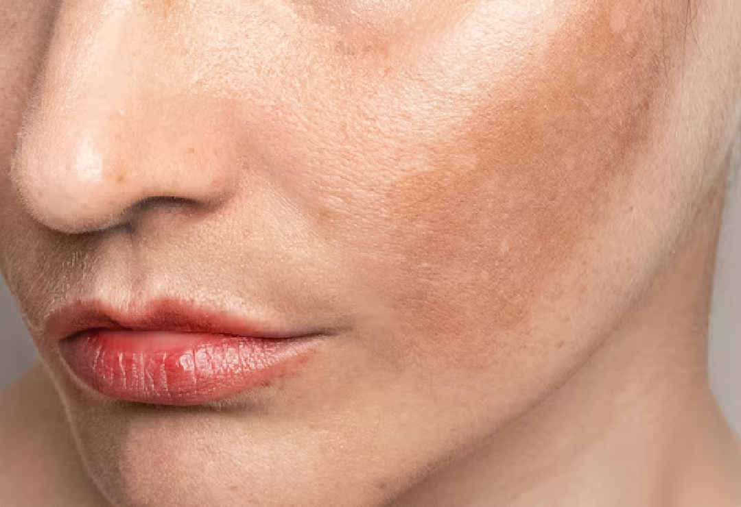 Melasma