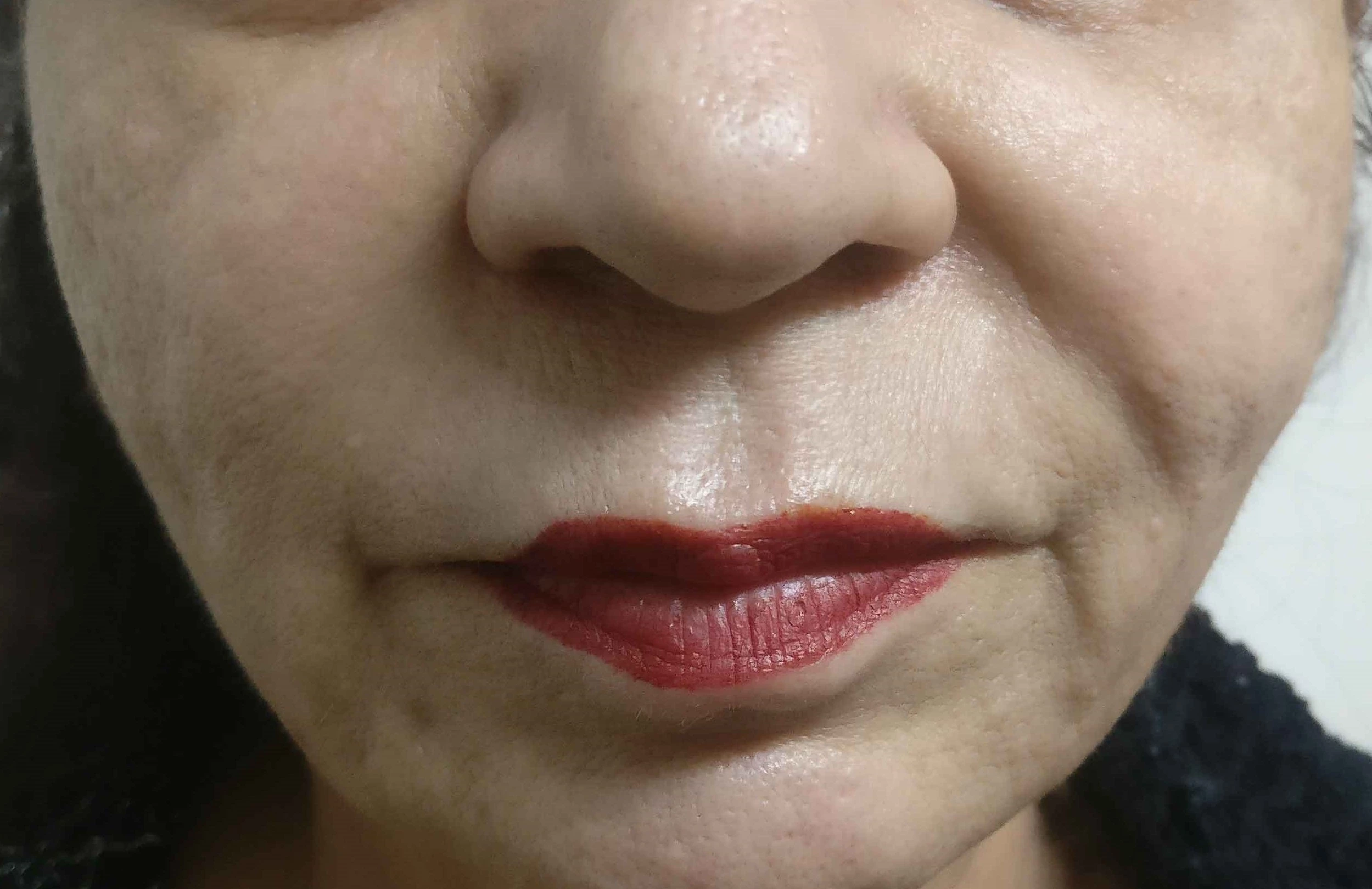 Fillers Treatment cost in Gurgaon