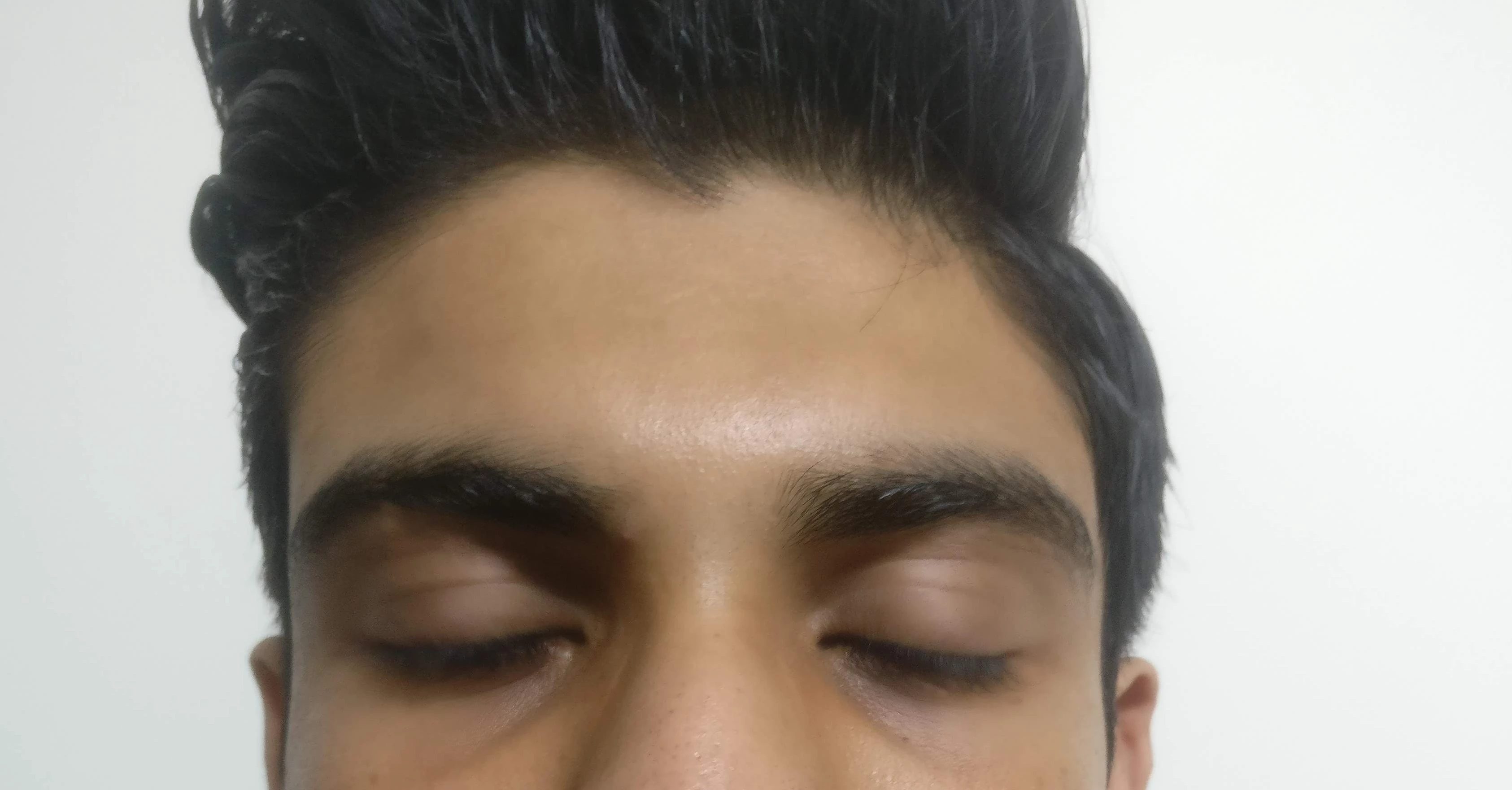 Fillers Treatment cost in Gurgaon