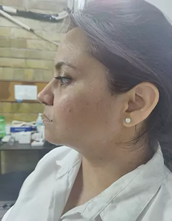 Dark Circles Treatment in Gurgaon