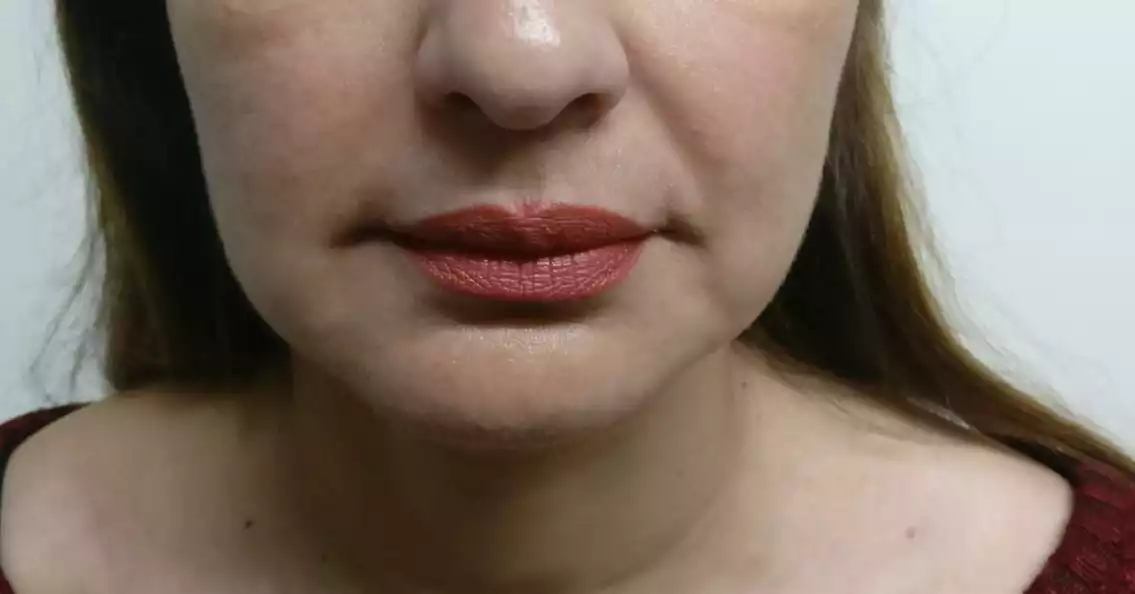 best Fillers Treatment in Gurgaon