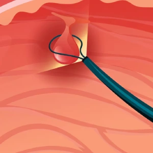 Cyst Excision Treatment in Gurgaon