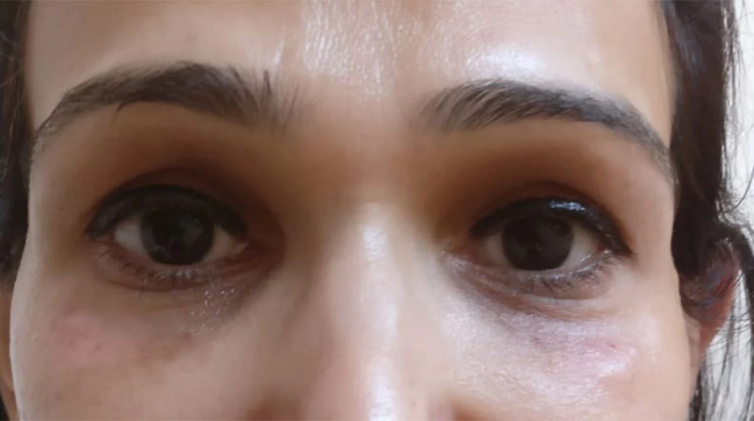 Fillers Treatment in Gurgaon