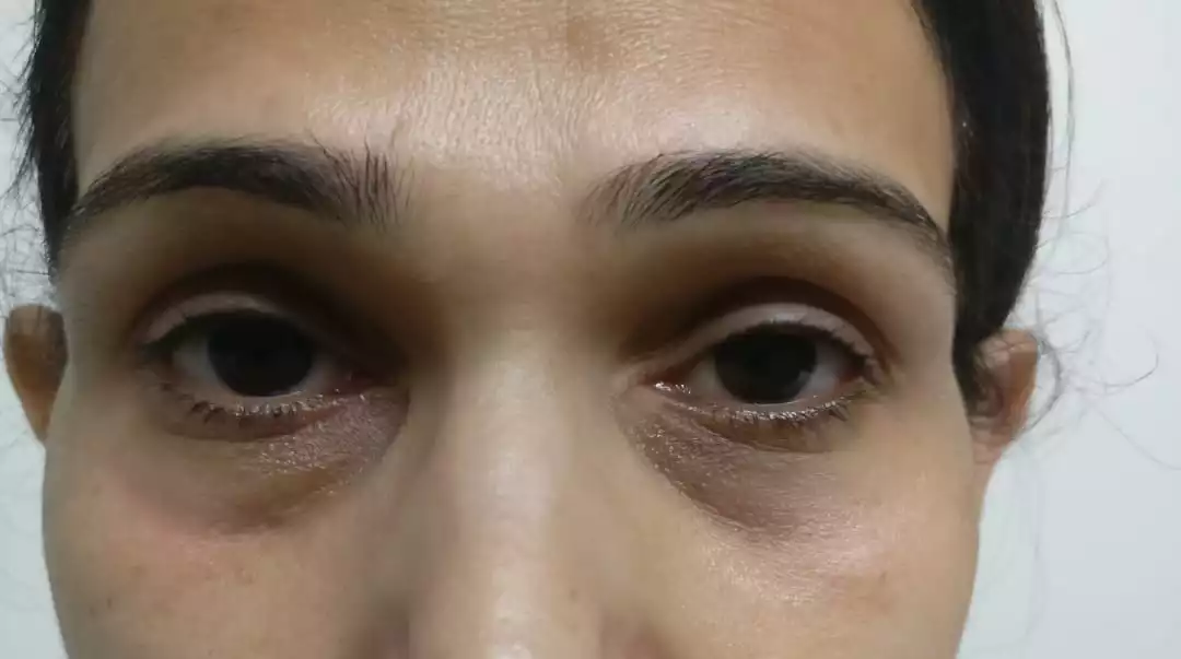 Fillers Treatment in Gurgaon