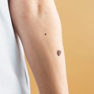 Skin Tag Removal in Gurgaon