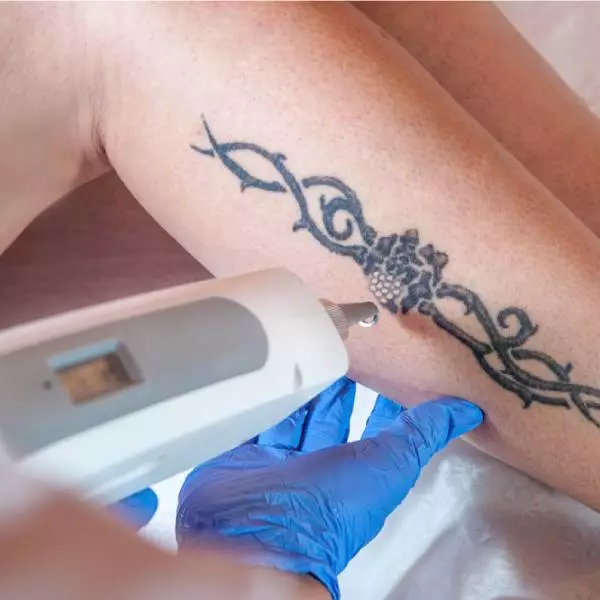 Laser Tattoo Removal in Gurgaon
