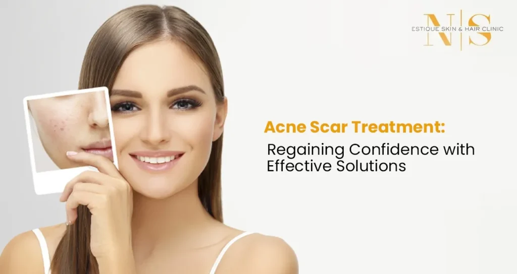 Acne Scar Treatment: Regaining Confidence with Effective Solutions