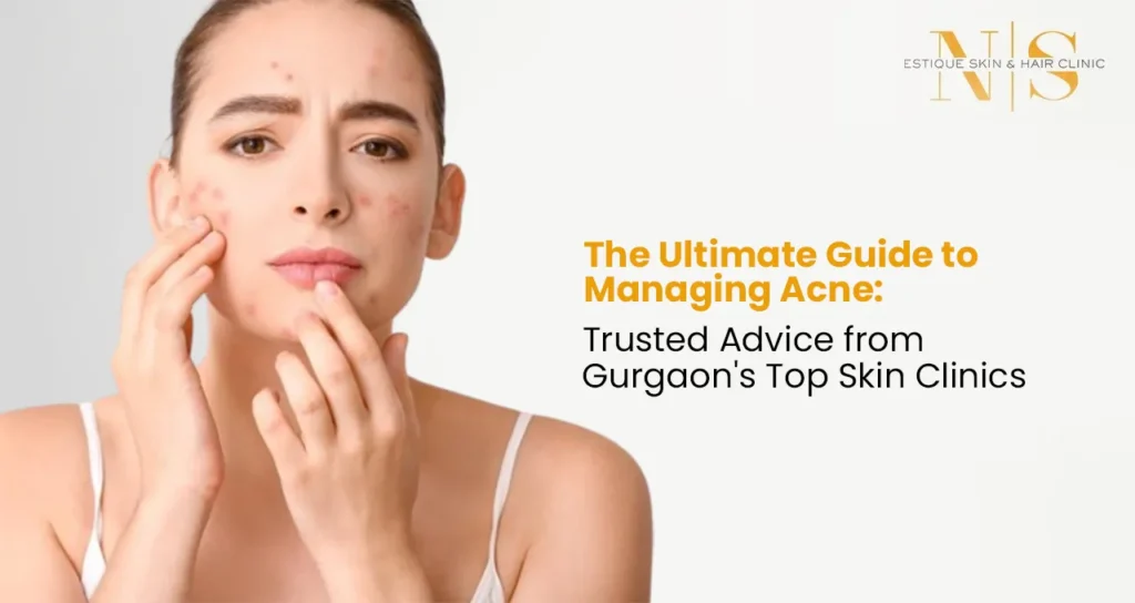 The Ultimate Guide to Managing Acne: Trusted Advice from Gurgaon's Top Skin Clinics