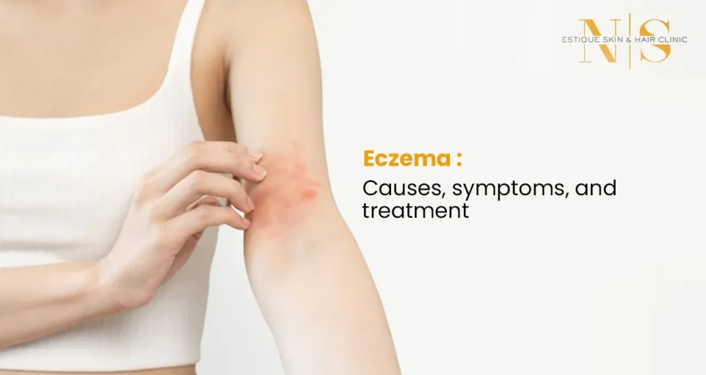 Eczema: Causes, symptoms, and treatment