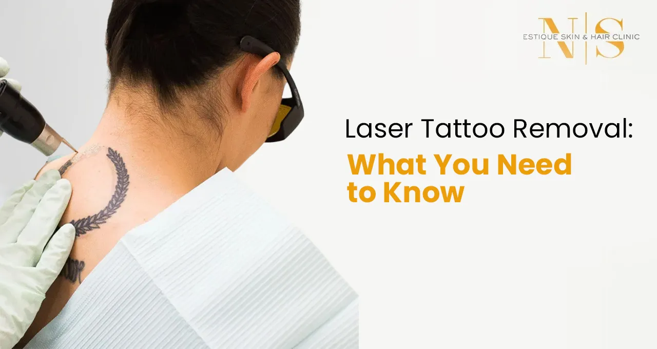 Laser Tattoo Removal: What You Need to Know