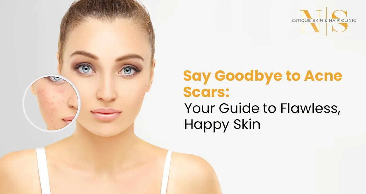 Say Goodbye to Acne Scars: Your Guide to Flawless, Happy Skin