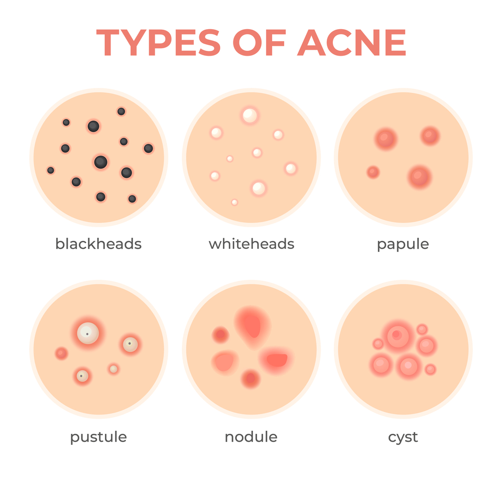 Types of Acne