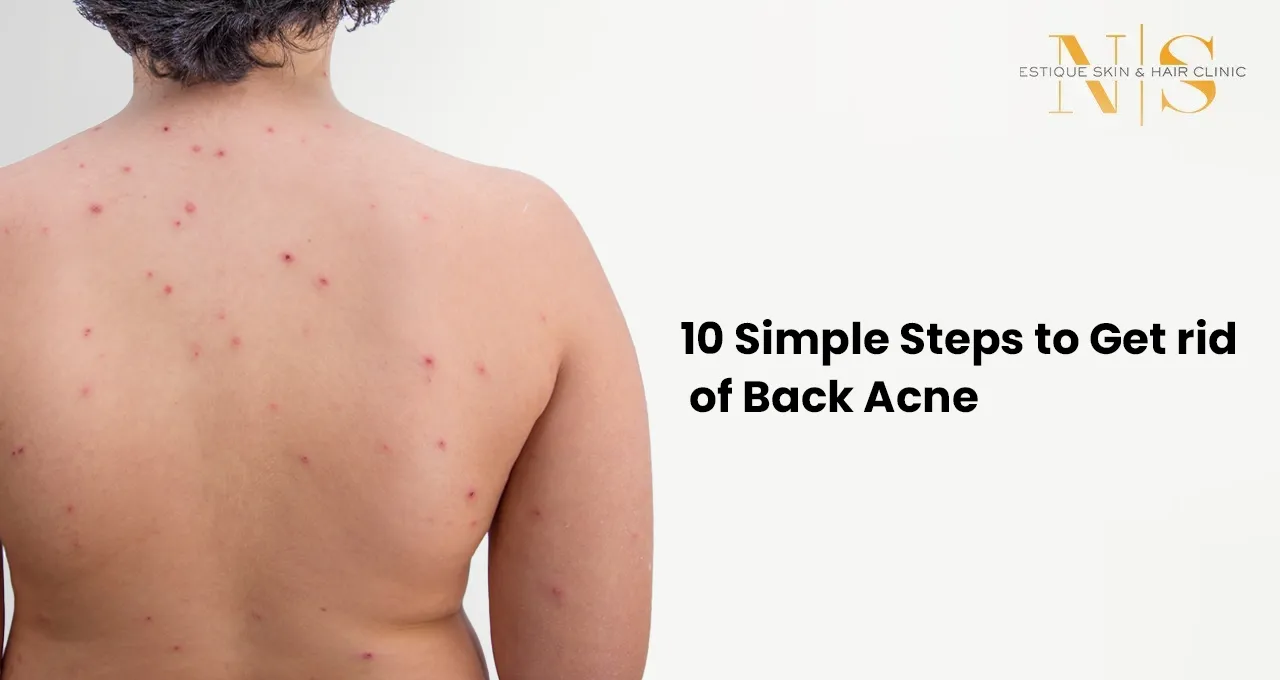 10 Simple Steps to Get Rid of Back Acne