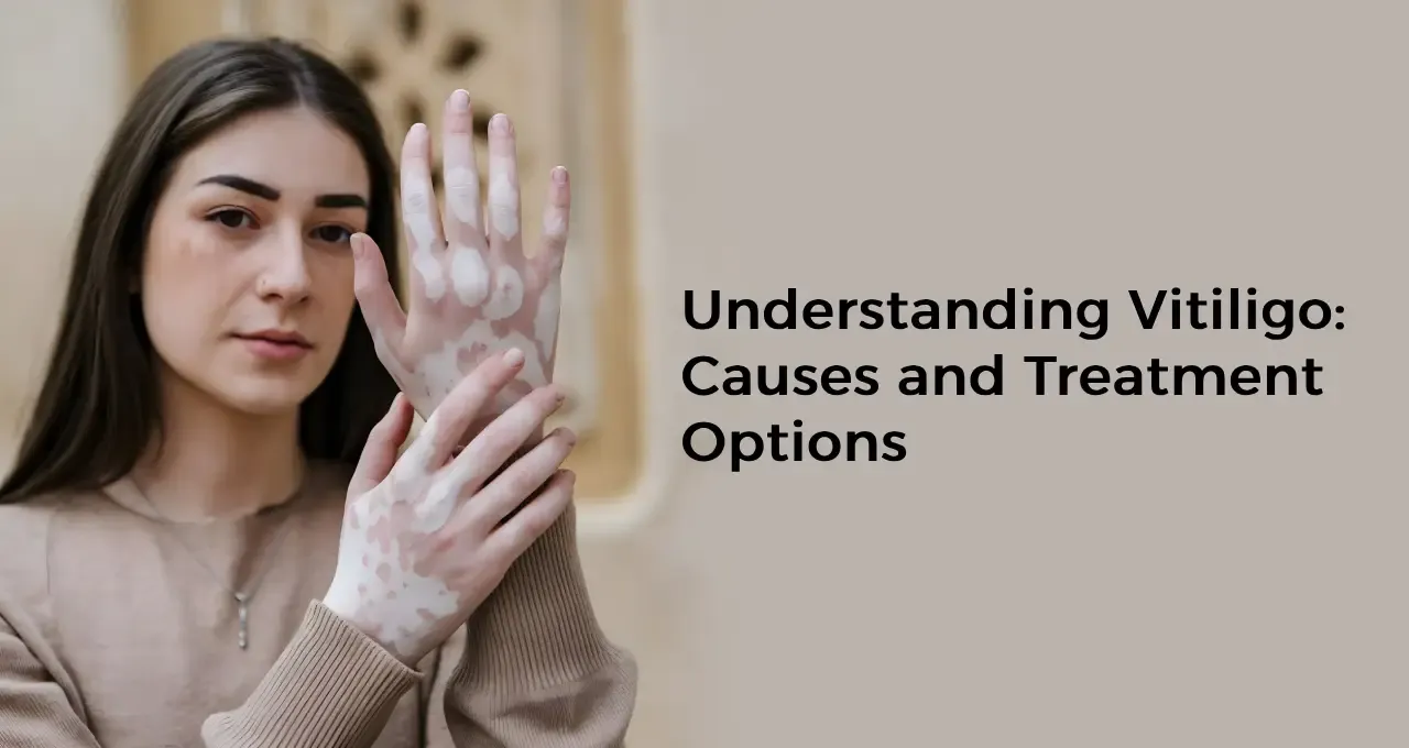 Understanding Vitiligo: Causes and Treatment Options