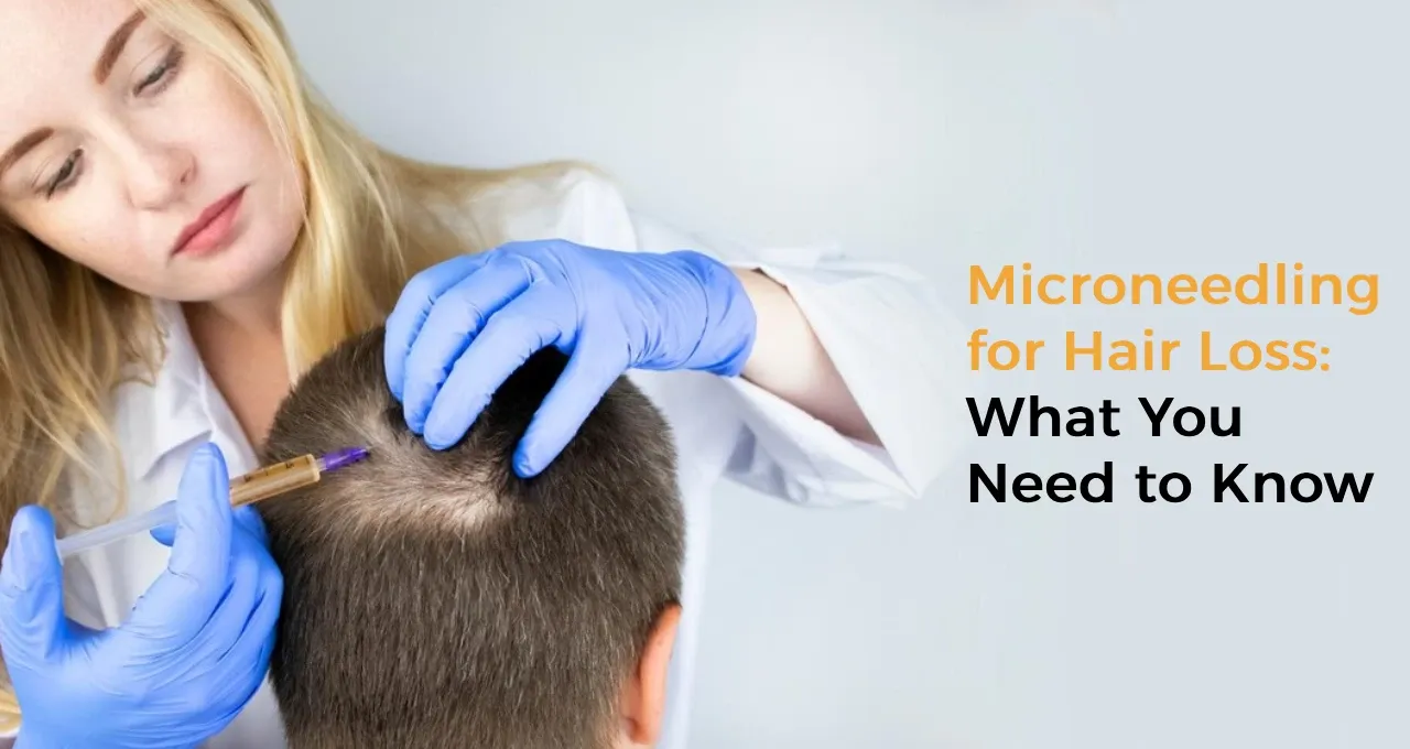 Microneedling for Hair Loss: What You Need to Know