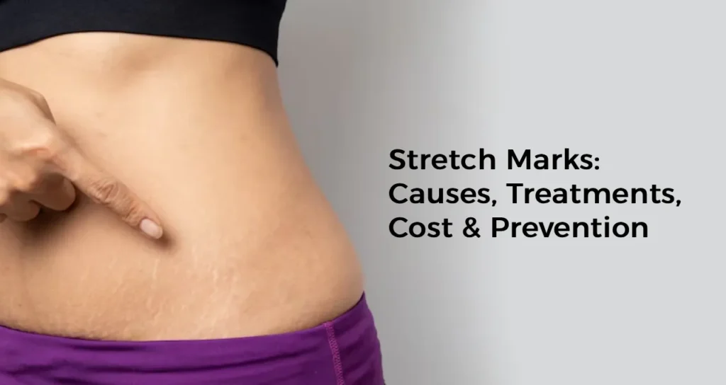 Stretch Marks: Causes, Treatments, Cost & Prevention