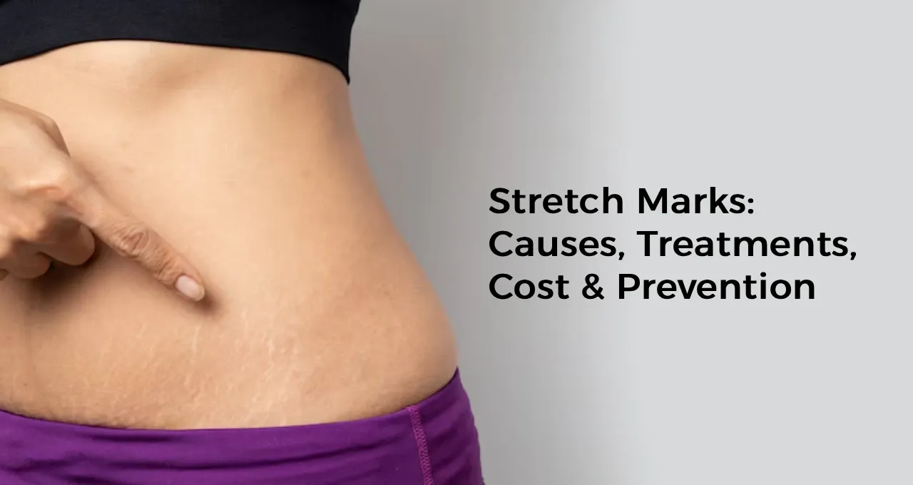 Stretch Marks: Causes, Treatments, Cost & Prevention