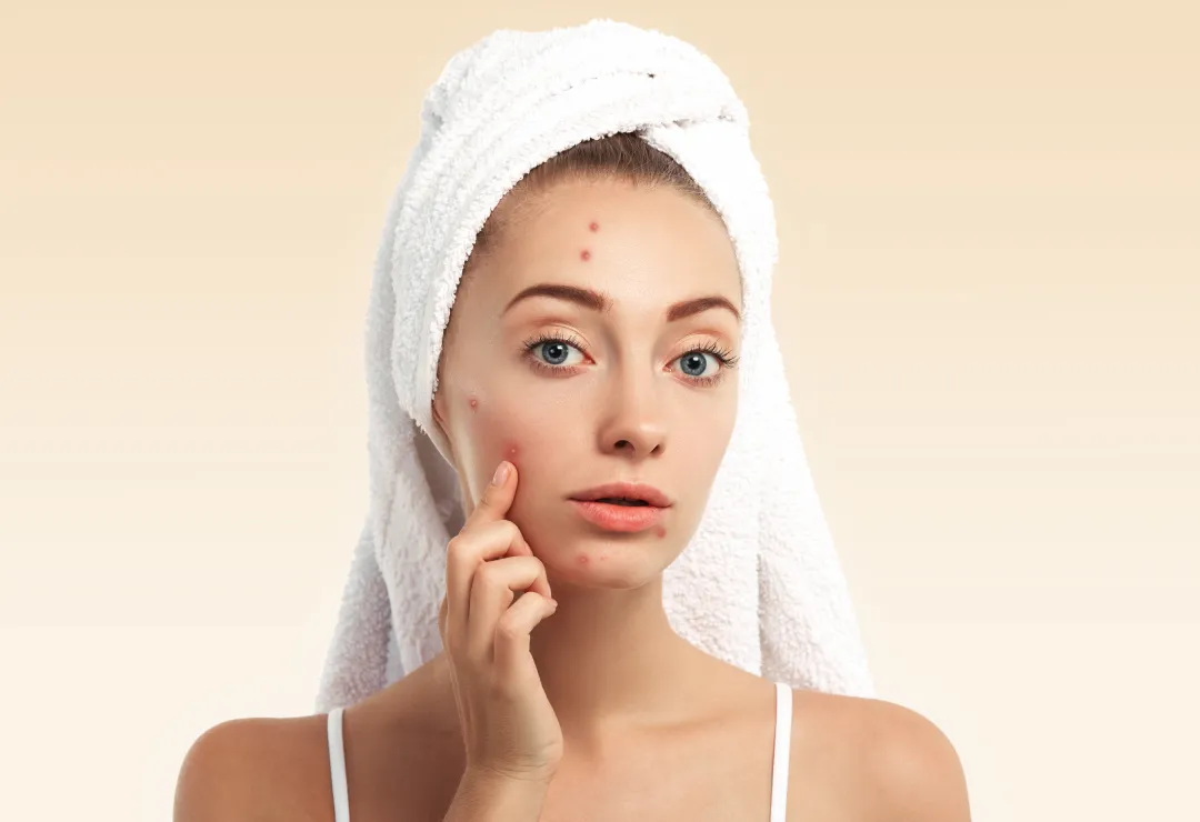 Acne-Scar-Treatment