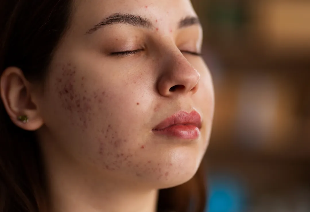 Acne Vulgaris Treatment
