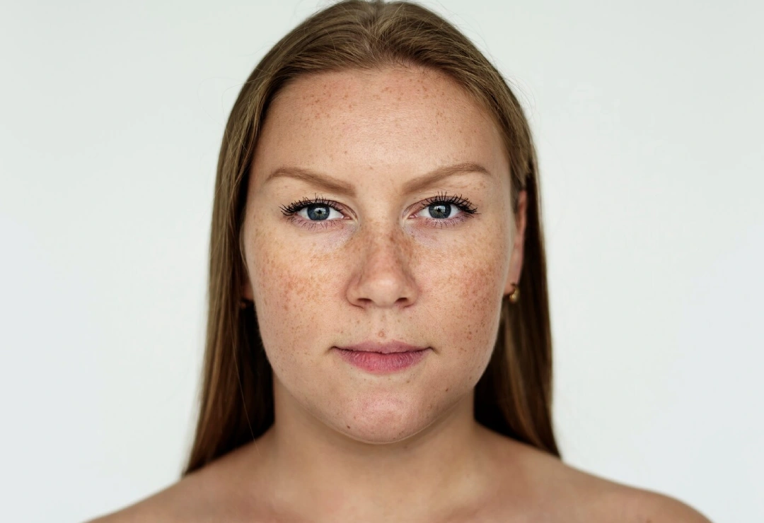 Melasma Treatment in Gurgaon