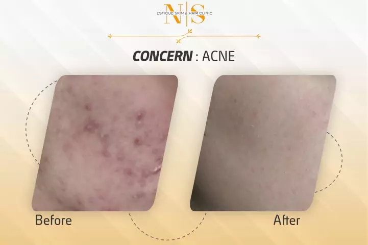 acne - before and after