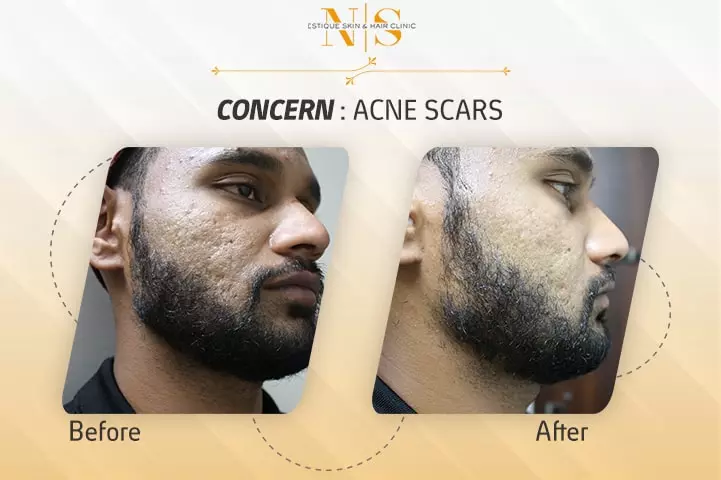 acne-scar -2 - before and after