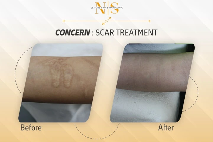 acne-scar - before and after