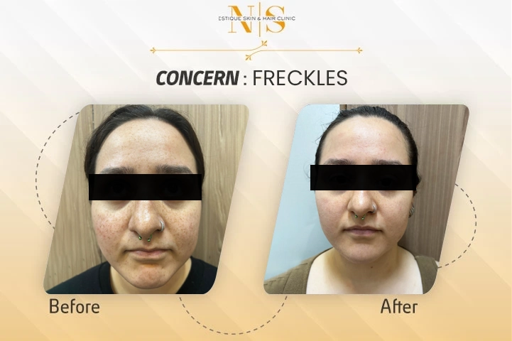 before-and-after-freckles-3