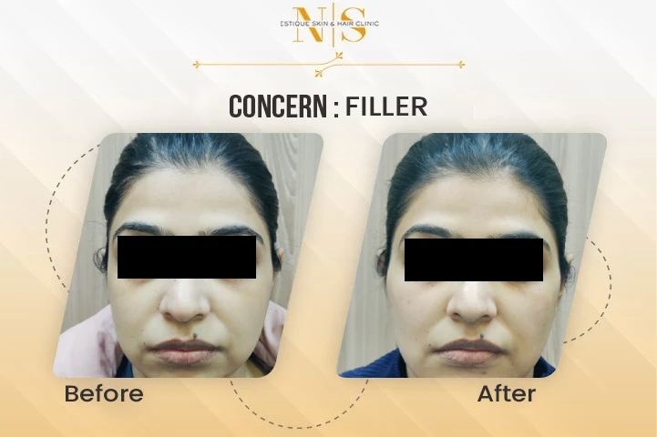 filler-before-after-new