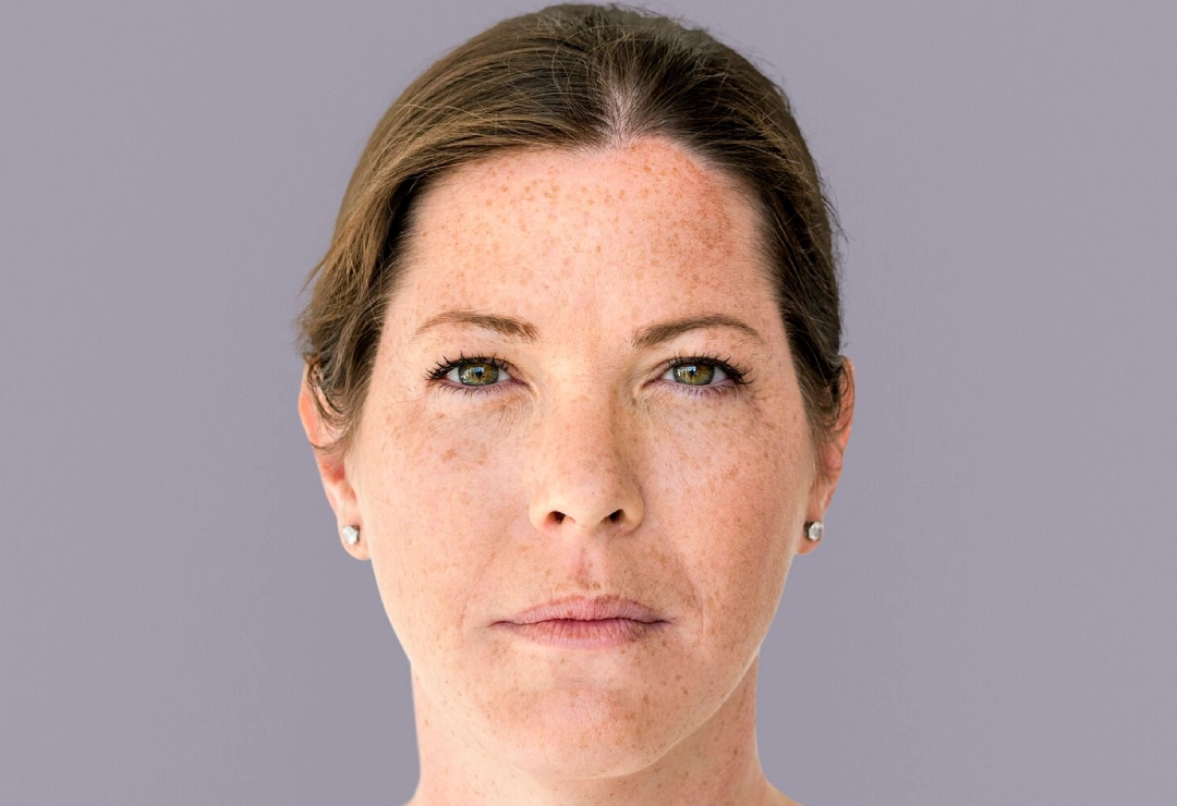 Pigmentation Treatment In Gurgaon