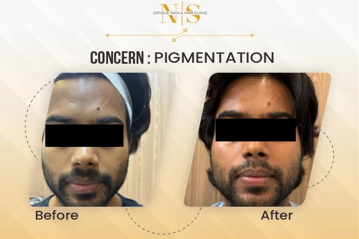 pigmentation-before-after-new