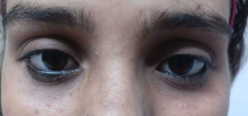 After Eye Filler