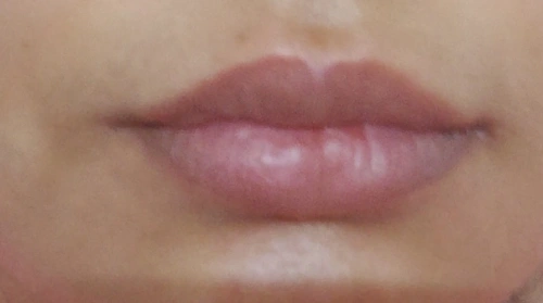 After Lip Fillers