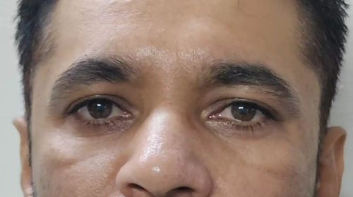 After Under Eye Rejuvenation