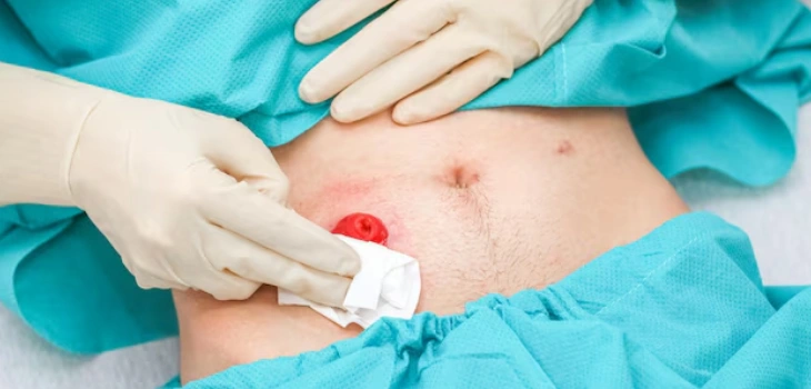 Cyst Excision Treatment in Gurgaon